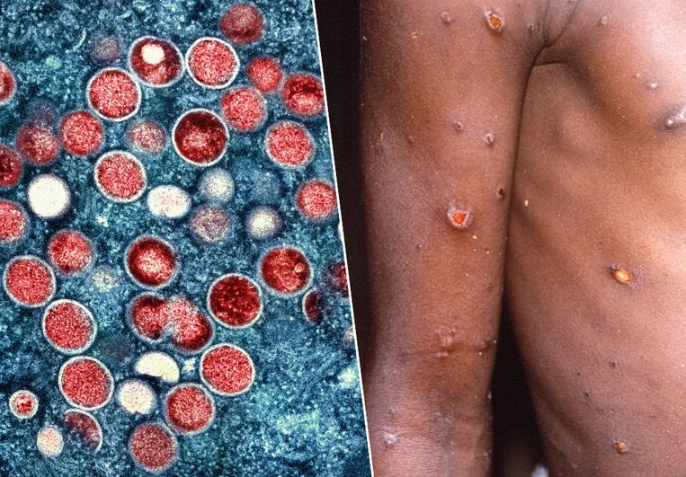 Zo zien monkeypox eruit vanbinnen en vanbuiten. 'De aanpak van ­monkeypox is weer een mooie case­study om te zien hoe snel de wereld zich kan organiseren.' Beeld AP/REUTERS