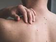 Dit zijn de drie verschillende soorten huidtumoren en zo kun je ze herkennen