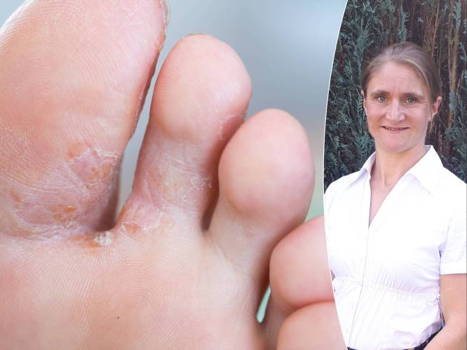 10% heeft last van voetschimmel: “Mensen met verminderde weerstand en ouderen zijn extra vatbaar”