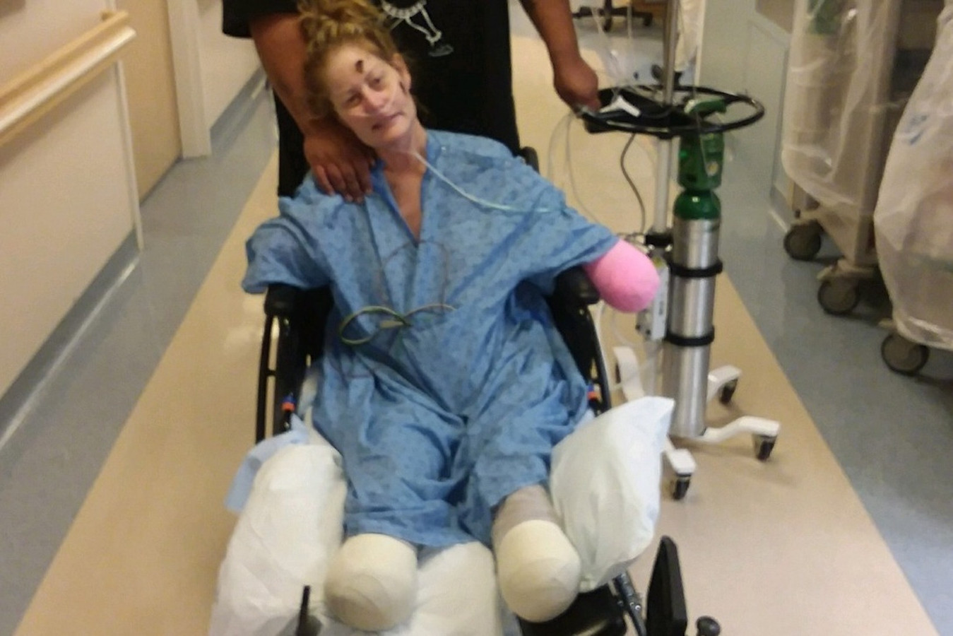 Инвалиды. Инвалиды. Ампутация нижней конечности. Сколько живут люди после ампутации. Сколько живут люди после ампутации.