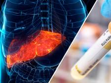 Al vier levertransplantaties bij kinderen, mysterieuze hepatitis ‘topje van de ijsberg’