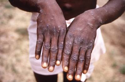 “La variole du singe n'est pas une urgence sanitaire mondiale pour le moment”