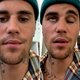 Justin Bieber getroffen door syndroom van Ramsay Hunt: helft van publiek vraagt geld terug