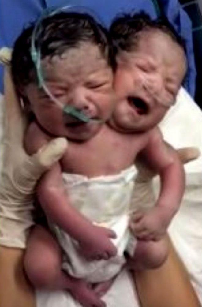 Le Triste Destin Du Bebe A Deux Tetes Famille 7sur7 Be