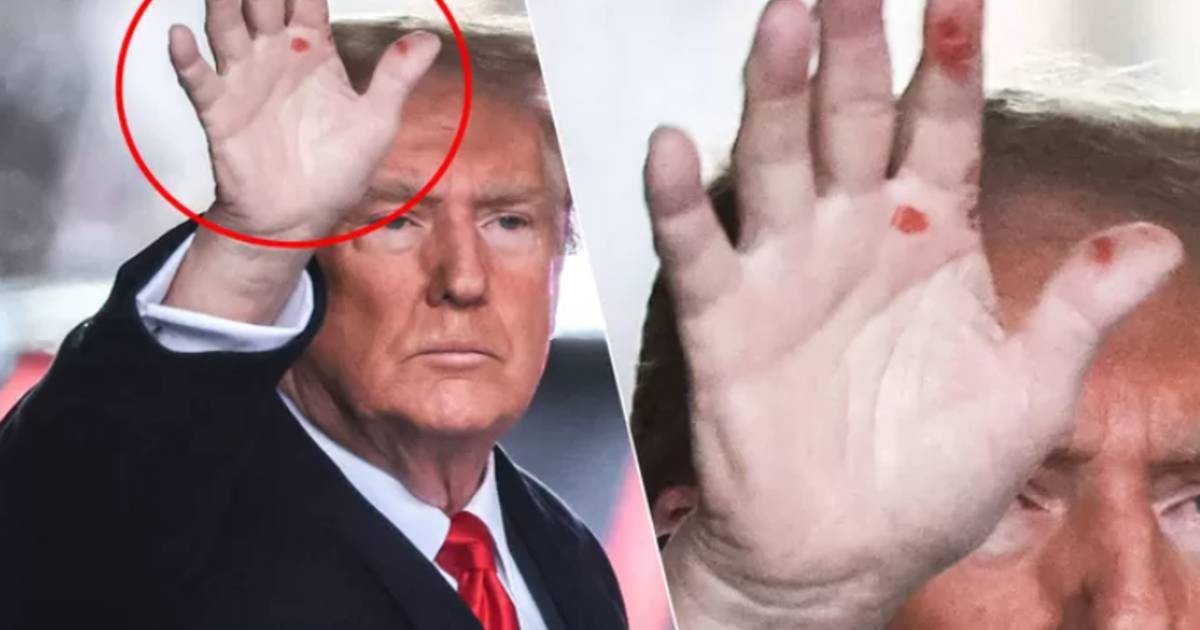 Cosa sono questi misteriosi segni rossi sulla mano di Donald Trump?  |  mondo