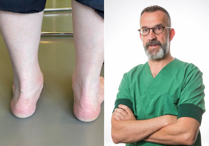 links: platvoeten. rechts: dr. Kris Buedts van het voet-enkelcentrum van ZNA.