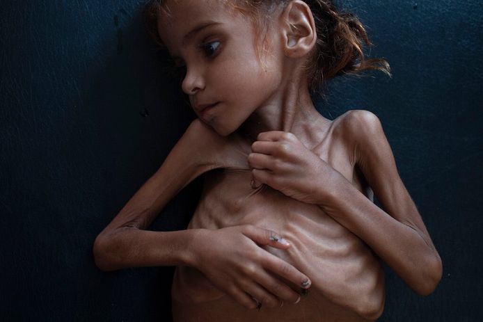 Amal Hussein is op zevenjarige leeftijd gestorven van de honger in een vluchtelingenkamp in Jemen.