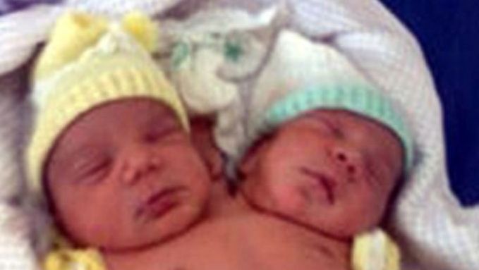 Un Bebe A Deux Tetes Ne Au Bresil Insolite 7sur7 Be