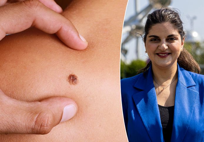 Samira Baharlou (UZ Brussel) legt uit wat je het best kunt doen als je een verdacht huidvlekje hebt.