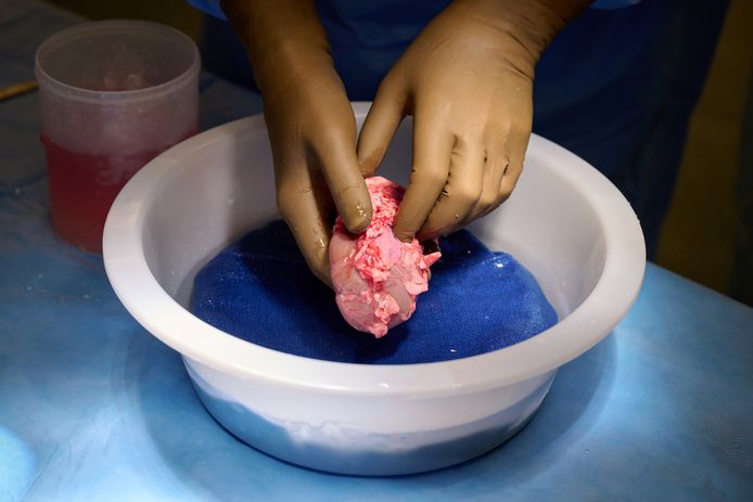 De genetisch gemanipuleerde varkensnier wordt schoongemaakt en klaargemaakt voor transplantatie.