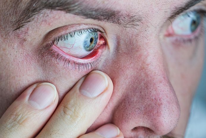 Droge ogen zijn een van de symptomen van het syndroom van Sjögren. Dr. Isabelle Peene (UZ Gent) legt uit wat het  inhoudt en wat je eraan kunt doen.
