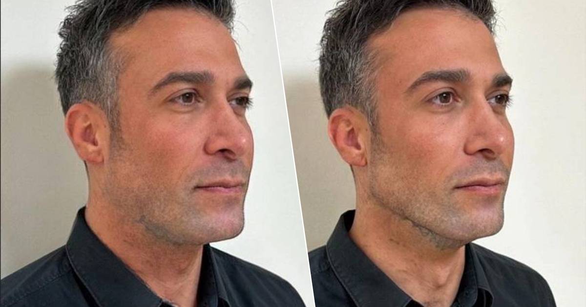 Fabrizio Tzinaridis Undergoes Jawline Tightening Treatment and Shaves Beard for the First Time in 18 Years