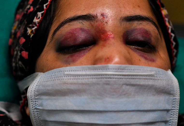 Een vrouw toont haar verwondingen.   Beeld AP