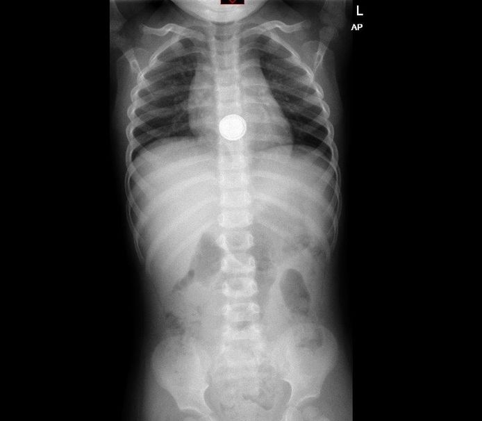 Kinderartsen Knoopcelbatterijen Inslikken Is Dodelijk Buitenland Hln Be