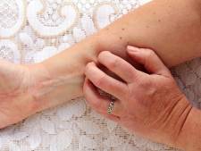 Paula en haar gezin hebben schurft: ‘Ik voel me bijna een melaatse’