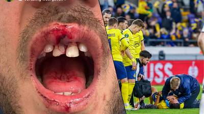 Dents abîmées et bouche ensanglantée: l’impressionnante blessure de Kevin Mac Allister face à Francfort