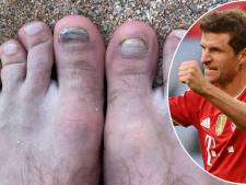 Thomas Müller montre une photo effrayante de ses pieds : “Je dois de toute urgence rendre visite à Nagelsmann”