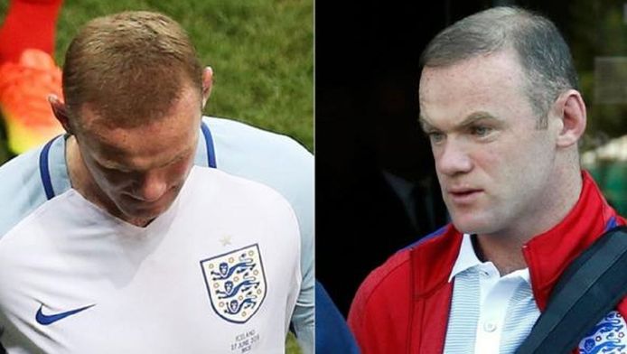 Selon le Daily Mail, qui s'est renseigné auprès d'un chirurgien capillaire, Wayne Rooney a plus que probablement utilisé un spray capillaire pour masquer sa calvitie.
