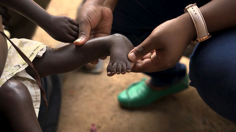 Beeld uit de documentaire van Luk Dewulf. Een 3-jarig meisje heeft klompvoetjes. Gehandicapte kinderen in Oeganda riskeren de 'genadedood'.  Beeld vrt
