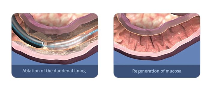 Via een katheter door de keel wordt een ballon, opgevuld met met warm water, met een endoscoop in de dunne darm (de twaalfvingerige darm) geschoven. De ballon verwarmt vervolgens de cellen volgens de methode 'Duodenum Mucosal Resurfacing (DMR)'. DMR is ontworpen om het slijmvlies van de dunne darm op een veilige manier te wijzigen.