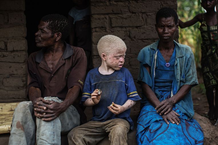 Kind met albinisme tussen zijn ouders in Malawi.  Beeld AFP