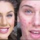 Cassandra Bankson geeft make-up tips tegen acné