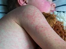 Alarm om mazelenuitbraak: OMT wil extra vaccins en broertjes en zusjes van patiënten weren van opvang