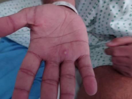 La variole du singe diagnostiquée pour la première fois chez des enfants aux États-Unis