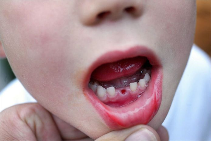 Tandartsen Bezorgd Over Rotte Tanden Bij Peuters En Kleuters Brabant Bndestem Nl