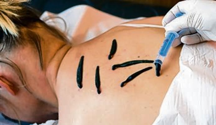 Een patiënte krijgt Medicinale bloedzuigers op haar rug gezet bij hirudotherapie: de behandeling van kwalen met behulp van medicinale bloedzuigers.