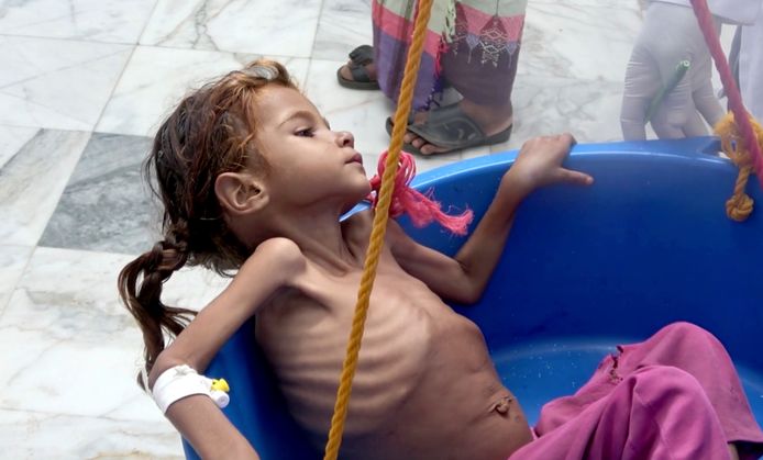 De zevenjarige ondervoede Amal Hussein wordt in augustus gewogen in Jemen. Vorige week werd bekend dat het meisje, dat door een foto in de New York het icoon voor alle hongerende kinderen in Jemen werd, gestorven is.