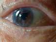 Drie patiënten UZ Leuven permanent blind aan één oog na routineoperatie