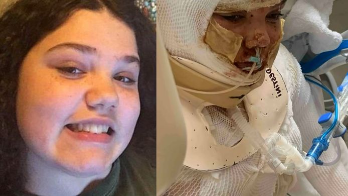 Destiny, 13, terluka parah setelah menantang Tiktok