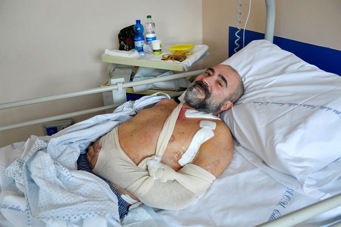 Marcello Gaviglio, een 55-jarige gezondheidswerker, moest zijn linkerbeen gedeeltelijk laten amputeren nadat hij vijf maanden geleden werd aangereden door een motorfiets.