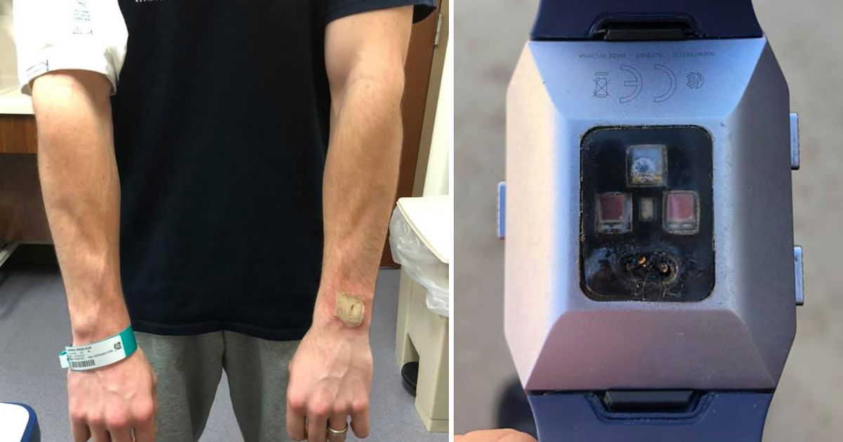 “Hij leek door mijn arm te smelten”: man omschrijft hoe hij zware brandwonden opliep door Fitbit