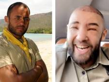 Mohamed de “Koh-Lanta” défiguré après une greffe de cheveux