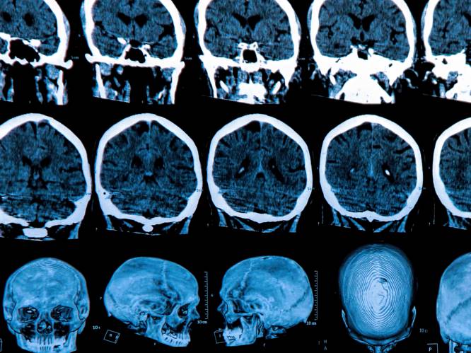 Zoveelste tegenslag: opnieuw twee studies naar Alzheimer stopgezet