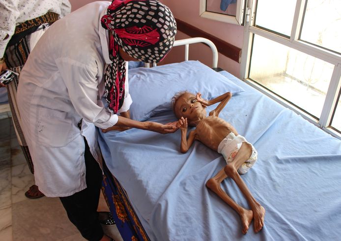Een verpleegster verzorgt een ernstig ondervoed kind in een ziekenhuis in Hajjah in het noordwesten van het land.