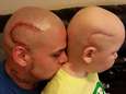 Vader laat kankerlitteken van zoon op hoofd tatoeëren