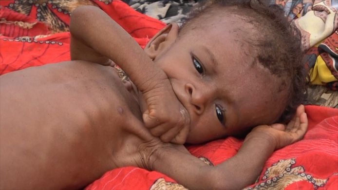 Door de burgeroorlog neemt ook het aantal doden door ondervoeding in Jemen toe.