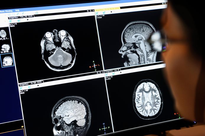 Een hersenenscan van een patiënt die lijdt aan een vorm van dementie.