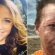 Man dumpt vrouw nadat ze verminkt raakte door een kampvuur