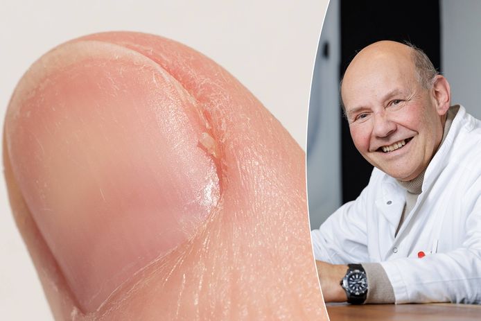 Losse velletjes aan je vinger kunnen bijzonder pijnlijk zijn. Dermatoloog Thomas Maselis vertelt hoe je ze aanpakt.