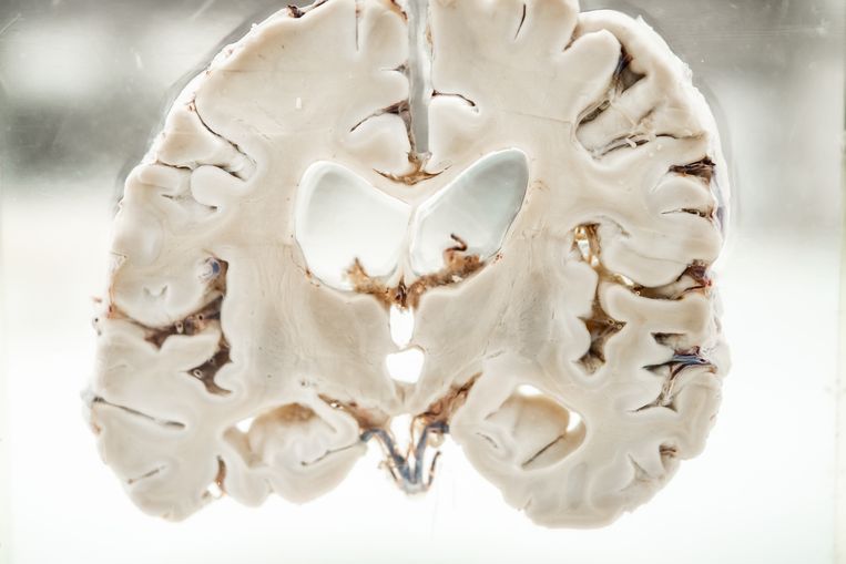 Een alzheimerbrein is kleiner dan dat van een gezond persoon. Beeld Joris van Gennip