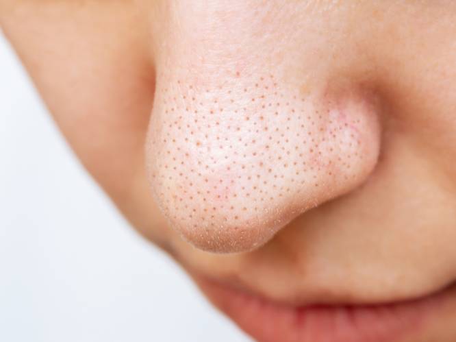 Dermatoloog geeft concrete tips voor minder zichtbare poriën in je gezicht: “Het zuur lost de talg in de poriën op”