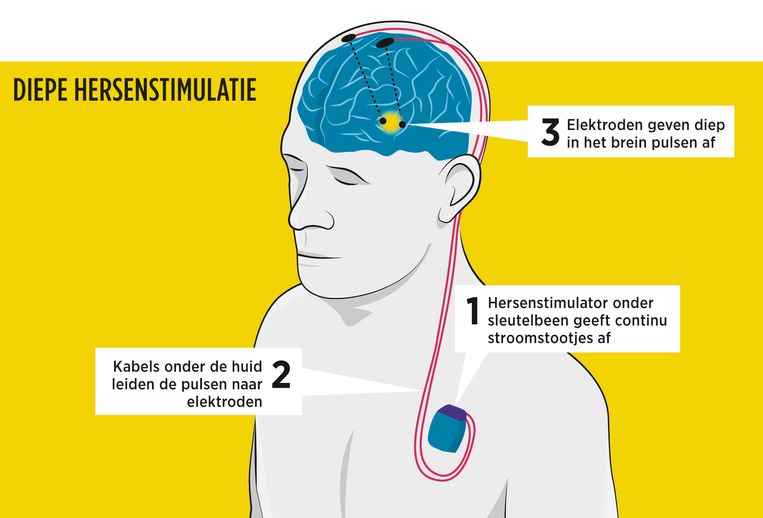 Kan Diepe Hersenstimulatie Helpen Bij Psychiatrische Aandoeningen