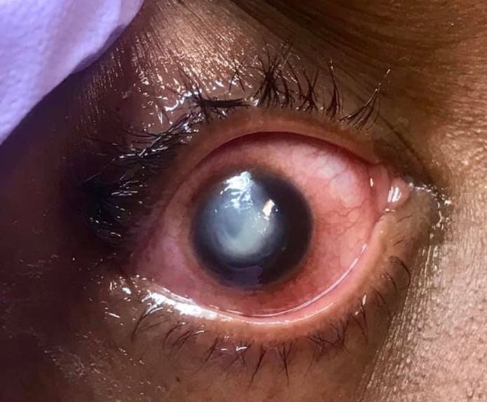 Un ophtalmologue a partagé ces images pour disuader ses patients de dormir avec leurs lentilles.