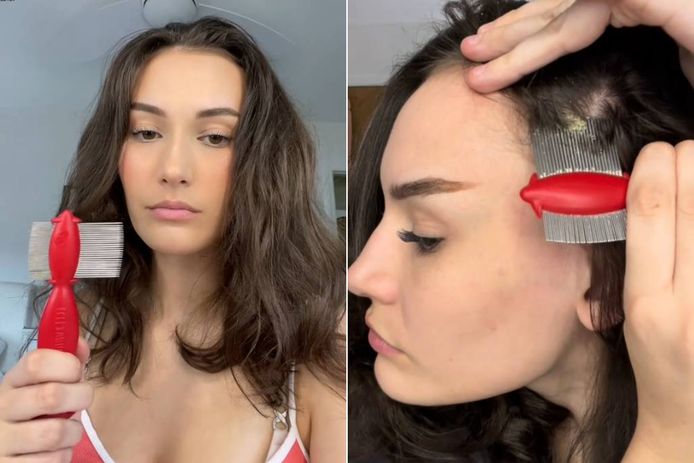Op sociale media kan je er bijna niet naast kijken. Heel wat mensen delen video’s waarin ze hun haarschilfers verwijderen.