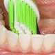 Vijf vragen over parodontitis