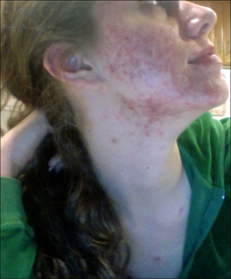 Wetenschappelijk onderzoek heeft twee boosdoeners van acne achterhaald. Zuivel is de belangrijkste. Beeld photo_news